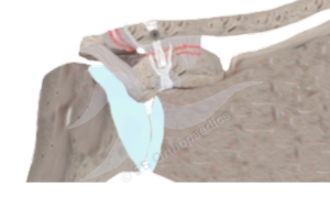 Physiotherapy Acromioclavicular joint (ACJ) stabilisation leaflet